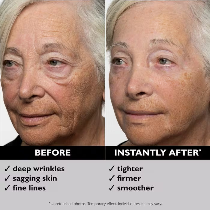 Before and after results of face tightening treatment