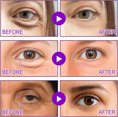 LOVILDS microneedle patch